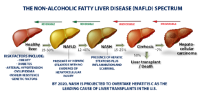 NAFLD, fatty liver disease progression, NASH